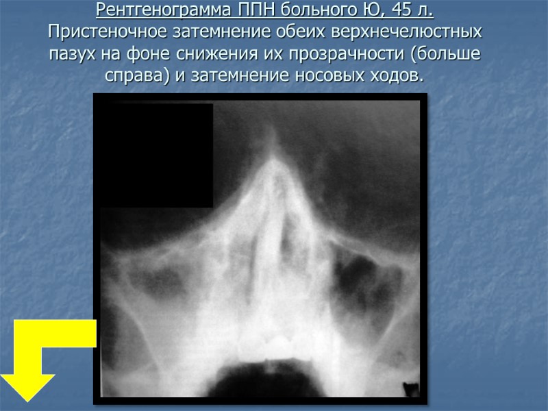 Рентгенограмма ППН больного Ю, 45 л. Пристеночное затемнение обеих верхнечелюстных пазух на фоне снижения
